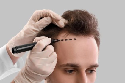 5 Things You Must Know Before Getting an FUE Hair Transplant in Melbourne